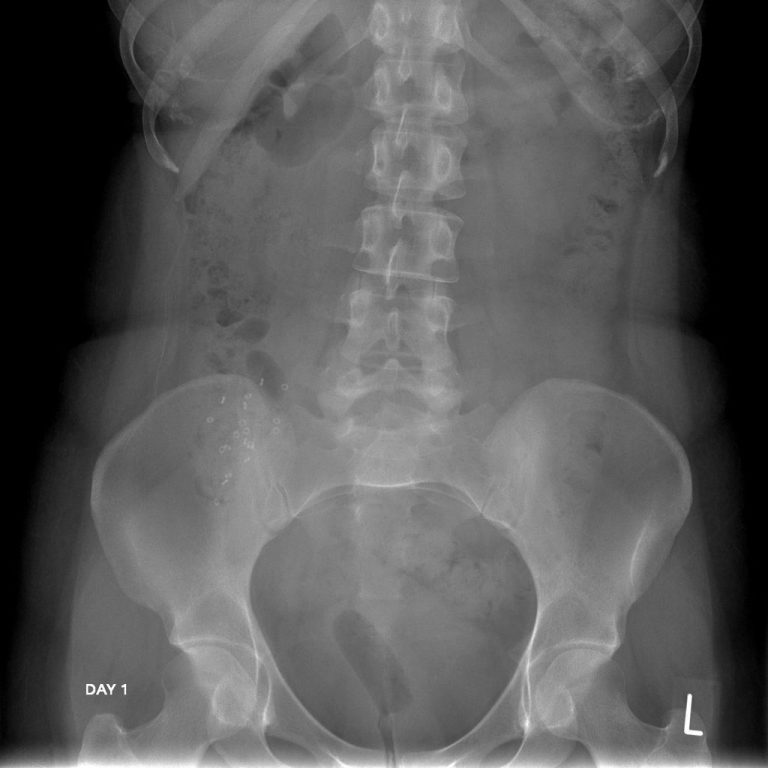 colon-transit-time-dr-salunkhe