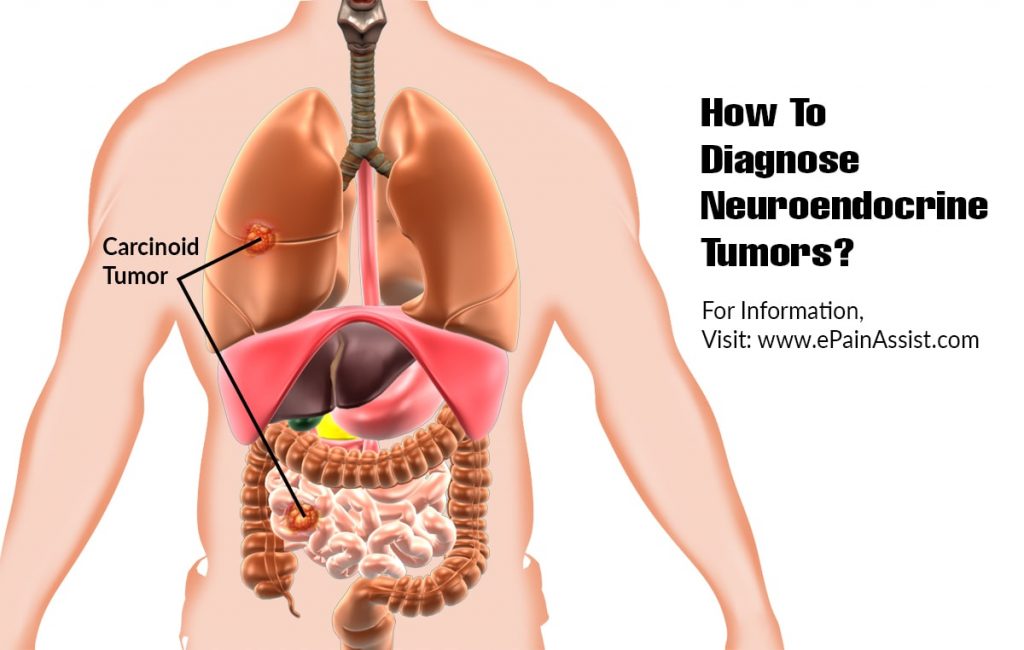 neuroendocrine-tumors-dr-sanjay-salunkhe