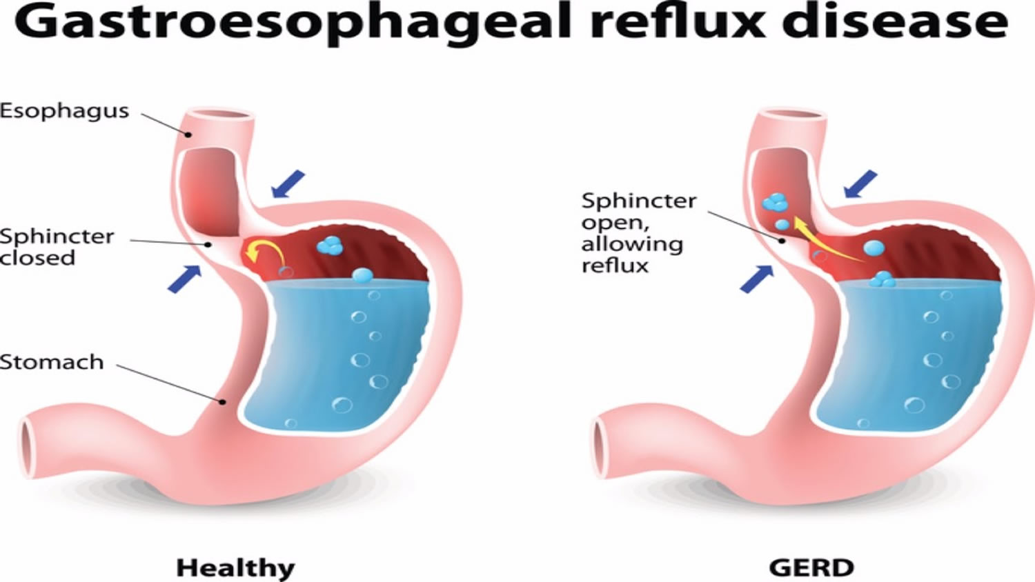 Reflux Esophagitis Drsalunkhe